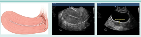 <p>what uterine phase is this (and endometrial thickness)?</p>