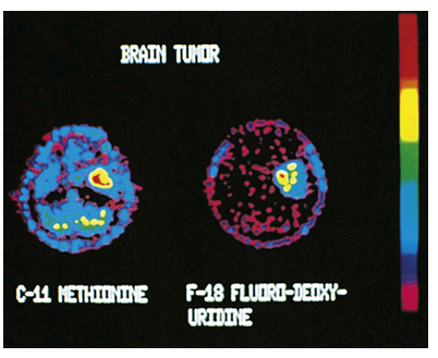 <p>It uses positron-emitting radionuclides (e.g., fluorodeoxyglucose F 18) to visualize organs and tissues of the body. The radionuclides decay, producing positrons that collide with electrons. A special camera detects photons released when the positrons and electrons collide. </p><p>Provides <strong><em>quantitative information regarding the structure and function of organs and tissues. It is commonly used to detect and monitor malignancies.</em></strong></p>