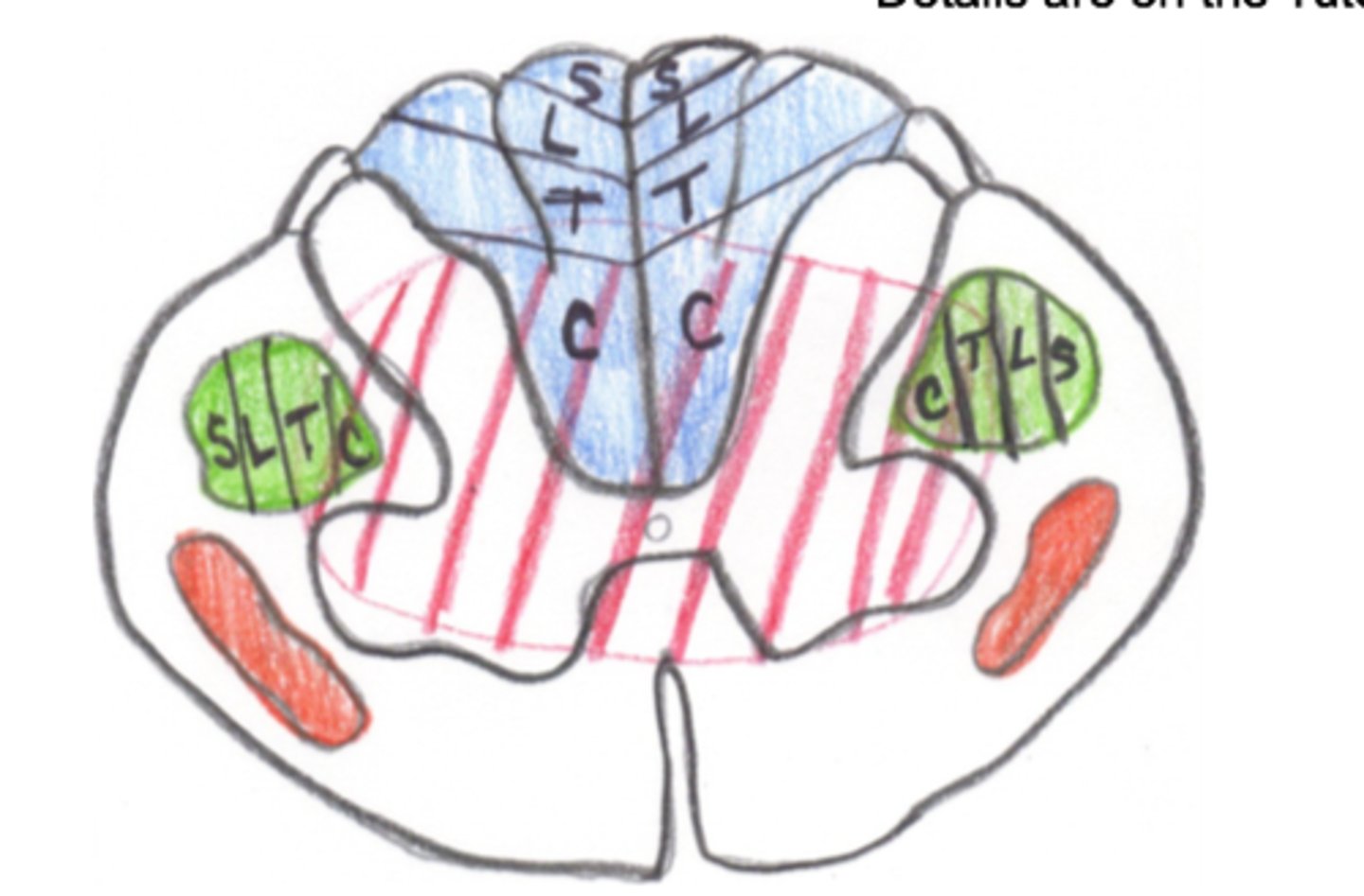 <p>This image depicts the damage associated with which Incomplete SCI Syndrome?</p>