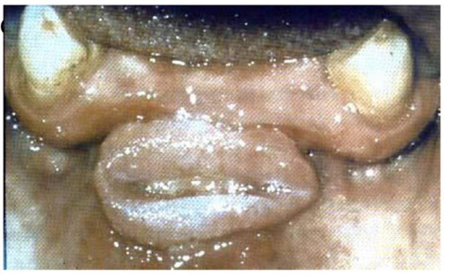 <p>Associated with chronic irritation - treatment is excision and creation of a new applicance</p>