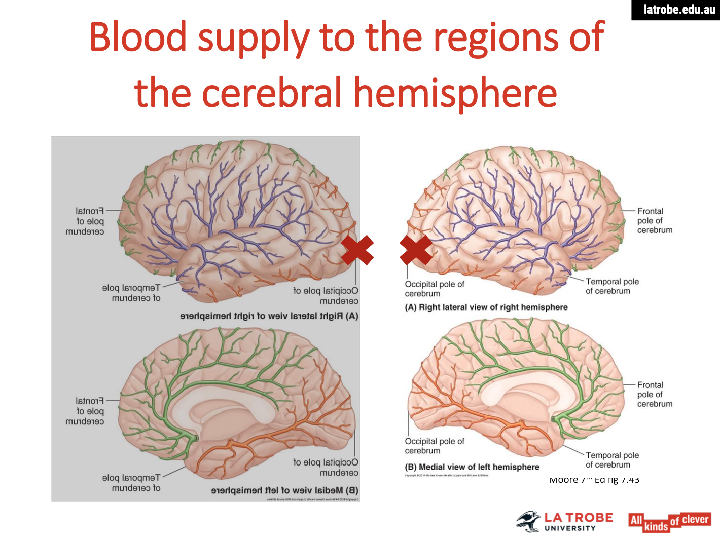 <p><span><strong>Impact of Blood Supply Blockage on Brain Function</strong></span></p><p><span><strong>Consequences of Blocked Blood Supply</strong></span></p><ul><li><p><span><strong>Brain Tissue Death</strong>:</span></p><ul><li><p><span>Tissue can die within minutes if deprived of blood supply.</span></p></li><li><p><span>Affected brain areas lose their ability to perform specialized functions.</span></p></li></ul></li></ul><p><span><strong>Potential Damage to the Occipital Lobes</strong></span></p><ul><li><p><span><strong>Location</strong>:</span></p><ul><li><p><span>The occipital lobes are located at the back of the brain, with a left and right hemisphere.</span></p></li></ul></li></ul><p><span><strong>Difficulties Resulting from Damage to Occipital Lobes</strong></span></p><ol type="1"><li><p><span><strong>Visual Processing Issues:</strong></span></p><ul><li><p><span><strong>Difficulty recognizing and interpreting visual stimuli.</strong></span></p></li><li><p><span><strong>Problems with visual memory, such as recalling what objects look like.</strong></span></p></li></ul></li><li><p><span><strong>Visual Field Loss:</strong></span></p><ul><li><p><span><strong>Hemianopia: Loss of vision in one half of the visual field in both eyes.</strong></span></p></li><li><p><span><strong>Quadrantanopia: Loss of vision in a quarter of the visual field.</strong></span></p></li></ul></li><li><p><span><strong>Agnosia:</strong></span></p><ul><li><p><span><strong>Inability to recognize familiar objects, faces, or places despite intact vision.</strong></span></p></li><li><p><span><strong>May affect the ability to understand visual information.</strong></span></p></li></ul></li><li><p><span><strong>Difficulty with Spatial Awareness:</strong></span></p><ul><li><p><span><strong>Challenges in judging distances or navigating spaces.</strong></span></p></li><li><p><span><strong>Problems with orientation, leading to difficulties in movement and balance.</strong></span></p></li></ul></li></ol><p><span><strong>Summary</strong></span></p><ul><li><p><span>Damage to the posterior parts of the occipital lobes can result in significant visual deficits, affecting a person’s ability to interpret and interact with their visual environment. This underscores the importance of blood supply to maintain brain function and the consequences of injury or disease.</span></p><img src="https://knowt-user-attachments.s3.amazonaws.com/f196a464-a991-40da-818b-2e148930335f.png" data-width="100%" data-align="center"></li></ul><p></p>