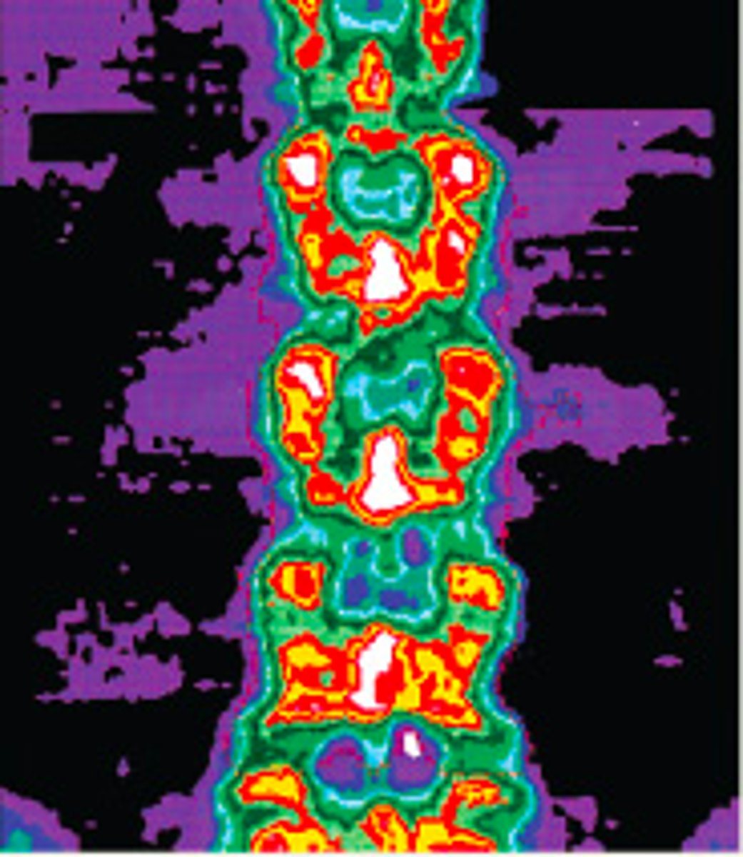<p>Fan beam, low dose radiation, looking at how dense bone is</p>