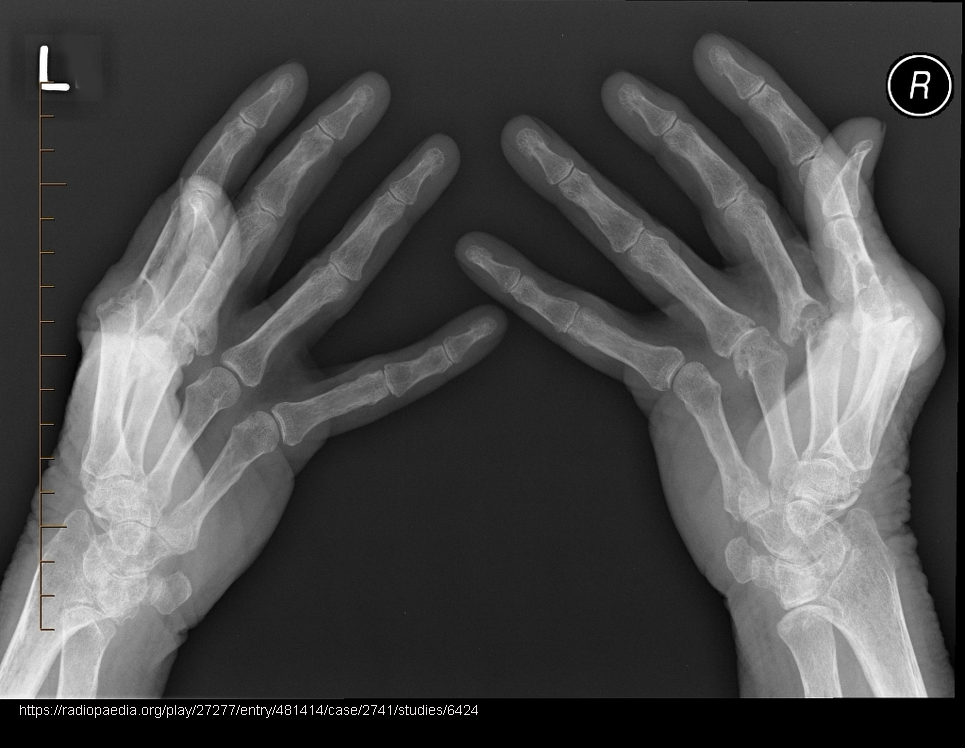 <p>Early: minimal bony change; later: osteoporosis/rarefaction, deformities.</p>
