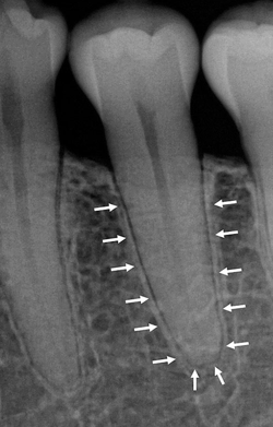 <ul><li><p>the wall of the tooth socket </p></li><li><p>made of dense cortical bone </p></li><li><p>a dense radiopaque line that surrounds the root of the tooth</p></li></ul><p></p>