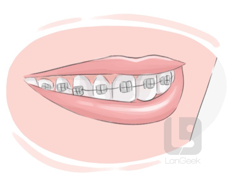 <p><strong>a set of connected wires that is attached to a person's teeth in order to make them straight:</strong></p><p><br></p>