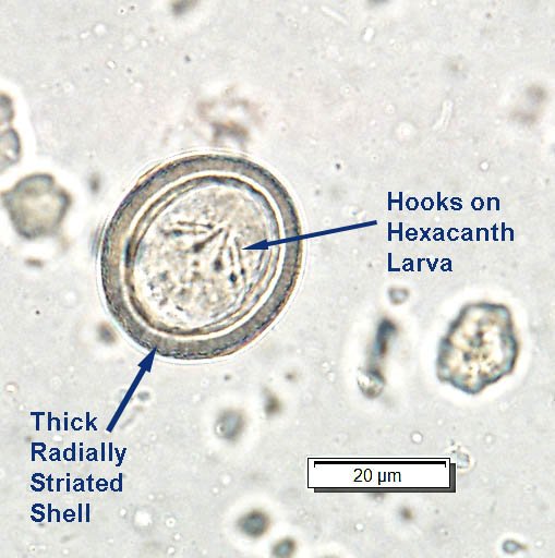 <p>Taeniasis</p><p>Helminth (platyhelminth, flatworm) - cestode (segmented)</p><p>pork/beef consumption</p><p>diagnosed via fecal smear</p>