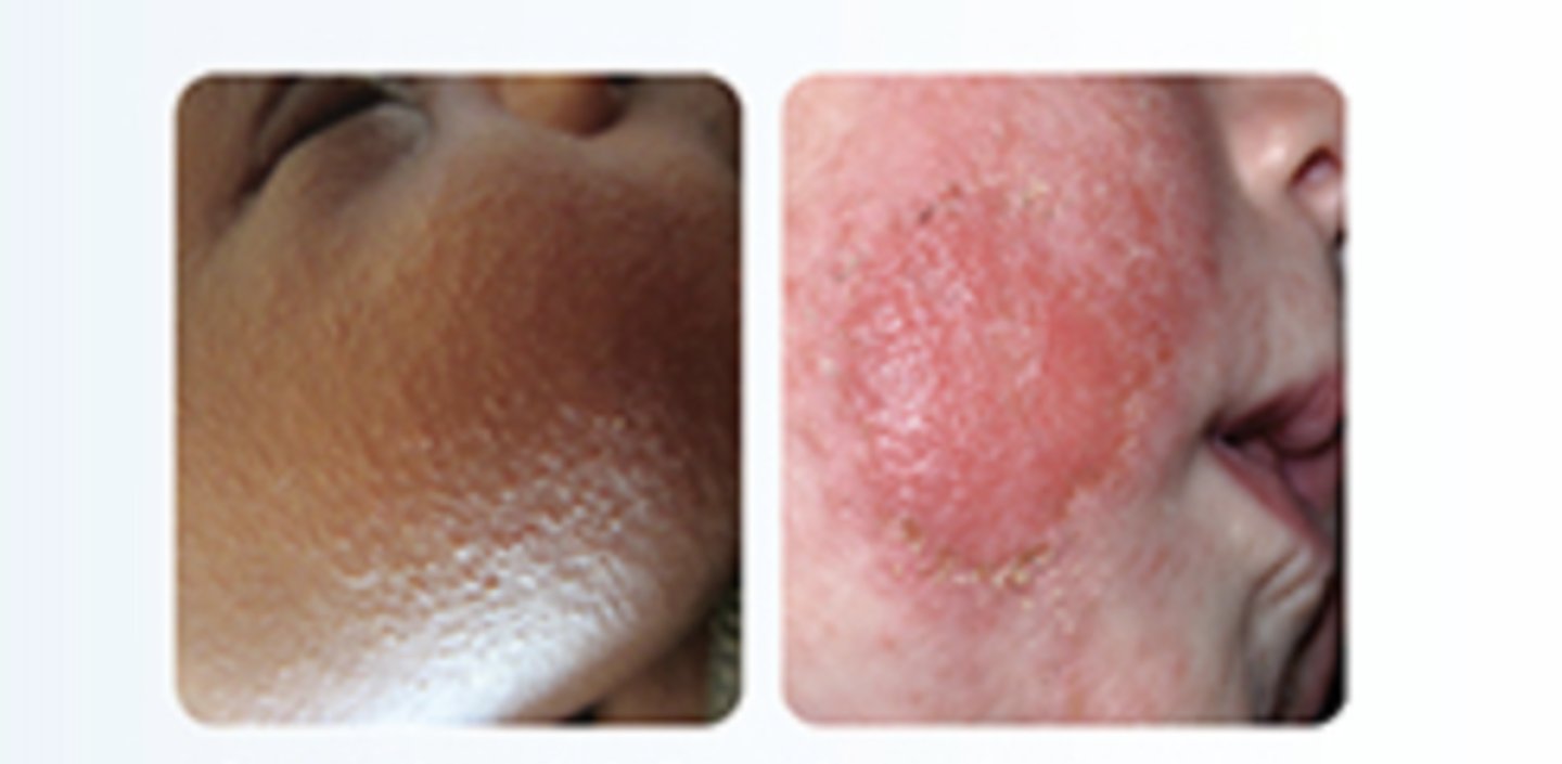 <p>acutely inflamed papules, vesicles, exudate, and crisis</p>