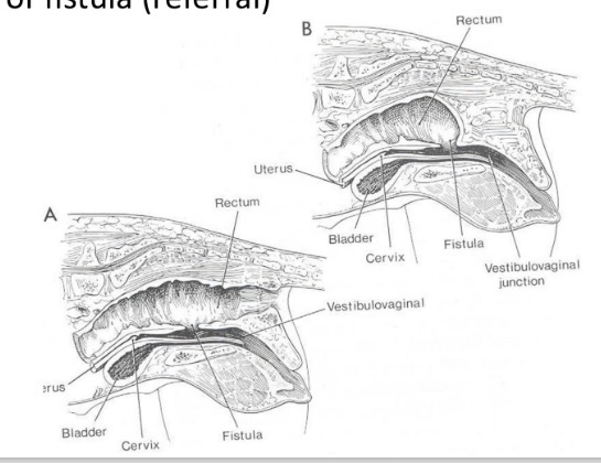 <p>communication between urethra + rectum persits (foetal cloaca) → urine passed from anus + vulva/penis </p><p>resect fistula </p>