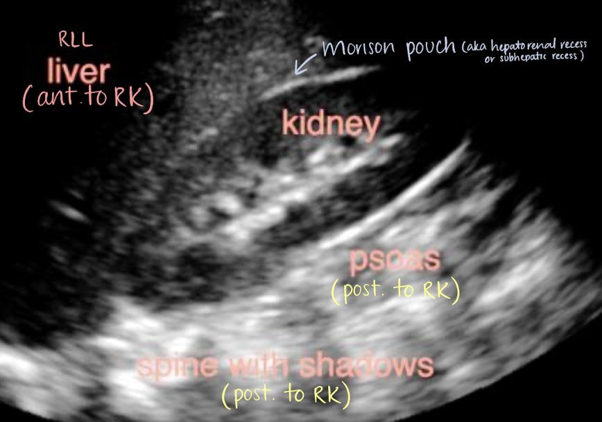 <ul><li><p>aka <em>hepatorenal recess</em> or subhepatic recess</p></li><li><p><mark data-color="yellow" style="background-color: yellow; color: inherit;">space between liver and RK</mark></p></li><li><p>patients may have ascites here</p></li><li><p><span style="color: yellow;">right posterior subhepatic space located anterior to kidneys and inferior to liver where fluid may collect</span></p></li></ul><p></p>