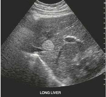 <p><span>A postmenopausal patient presents with a history of right upper quadrant pain and normal liver function tests. She denies hormone replacement therapy or previous abdominal surgery. A solitary mass is identified in the right lobe of the liver. This mass most likely represents a(n):</span></p>