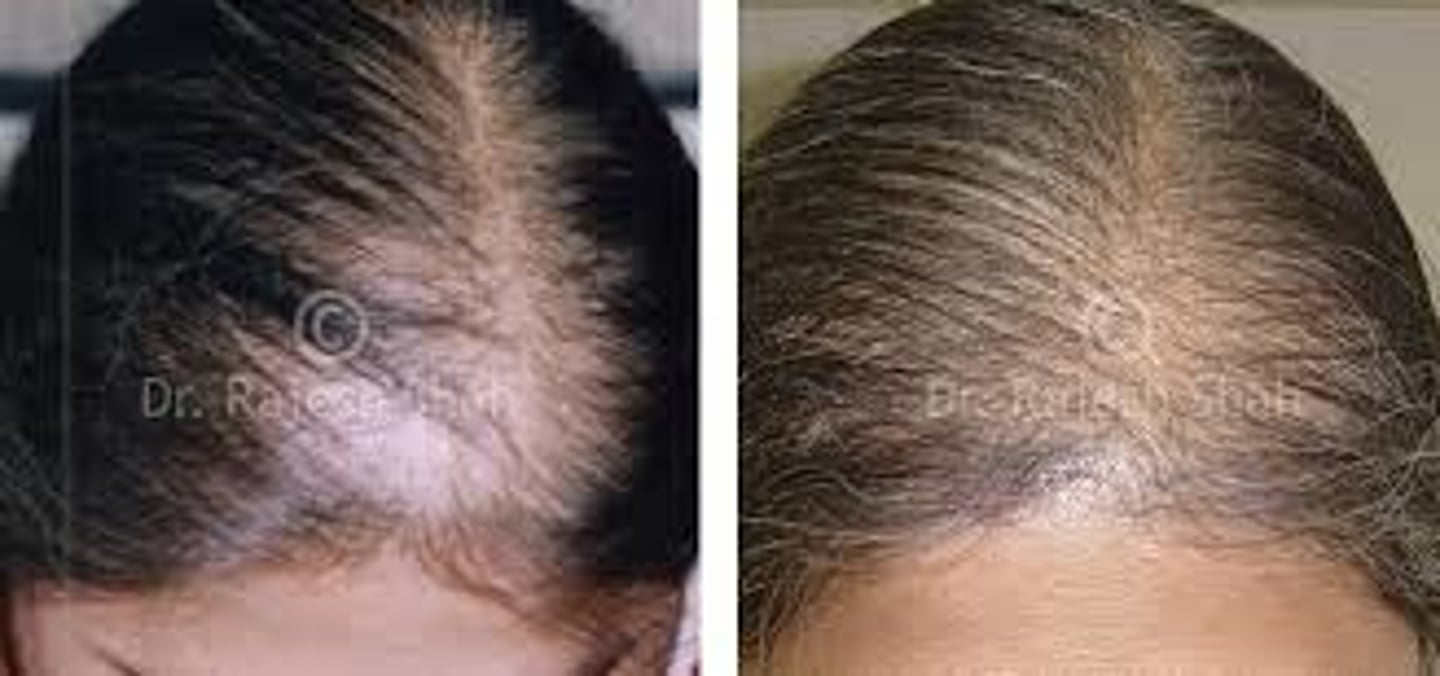 <p>diagnose this:</p><p>hair thinning across crown (frontal hairline preserved) part wider anteriorly</p>