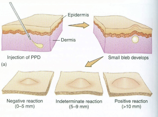<p>positive skin reaction: hard, dense wheal (red, itchy raised welt), indicates propr exposure. negative skin reaction: no hard, dense, raised mass</p>