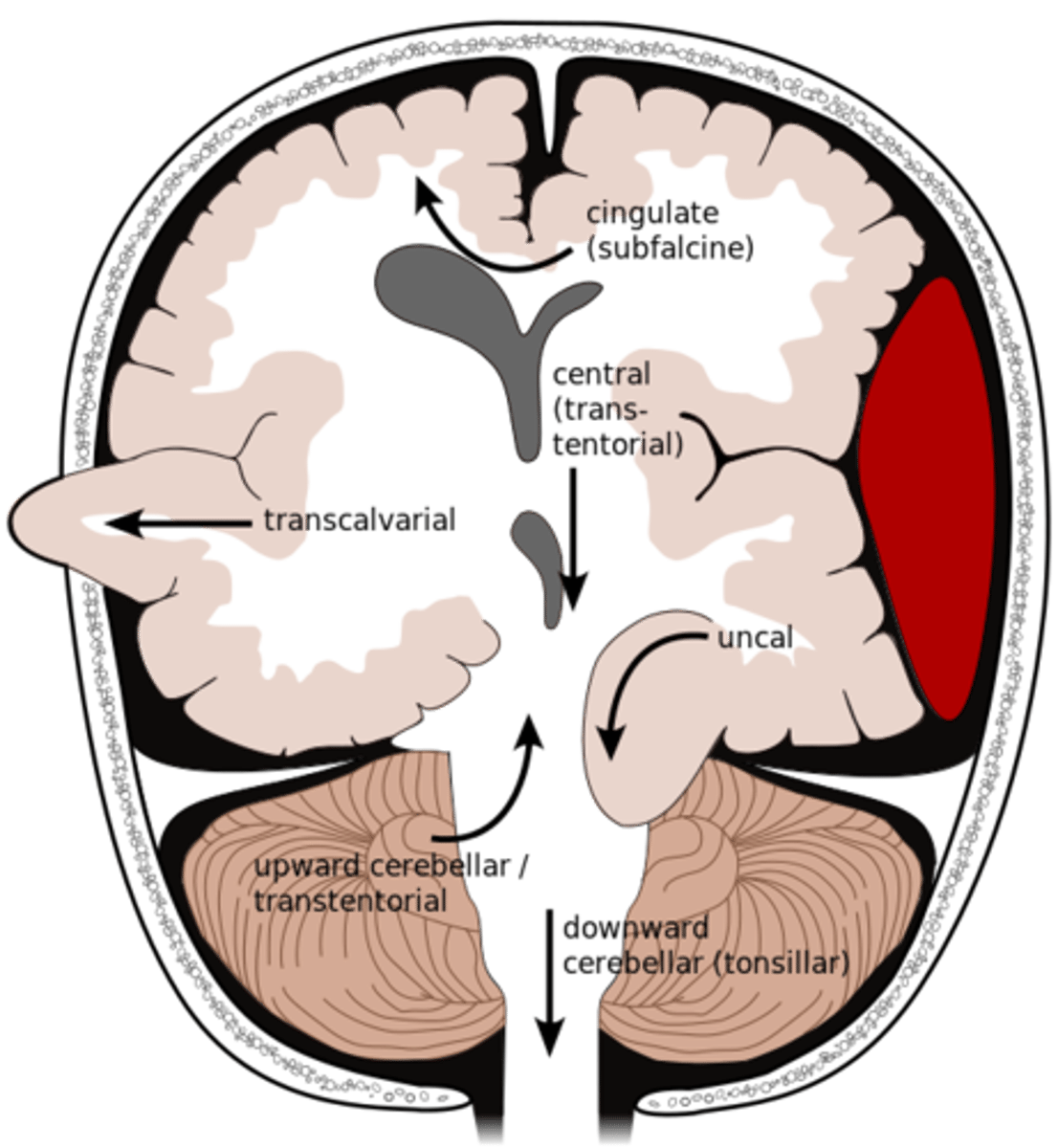 <p>-Midline shift</p><p>-Uncal/Lateral (only time where pupillary changes are first sign)</p><p>-Transtentorial/Central</p><p>-Through Fracture</p><p>-Foramen Magnum (deadly)</p><p>-Space-occupying</p>