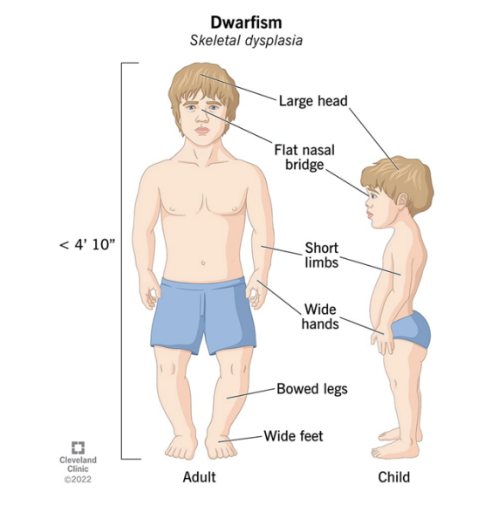 <p>CASE: All MESODERM-derived bones (i.e., limbs, spinal column, and thoracic cage) are affected and shorter-than-normal amongst Achondroplastic/Skeletal Dysplastic patients (a type of dwarfism) but their faces are normal and almost adult-looking - which seem unaffected. This is because the “skeleton-of-the-face” called Viscerocranium and “forehead” called frontal bone of the neurocranium, which are not affected in most types of dwarfism, are derivatives of: (Kindly check illustration courtesy of Cleveland Clinic)</p><p>A. Neuroectodermal cells</p><p>B. Neural crest cells</p><p>C. Placode cells</p><p>D. Surface ectoderm cells</p>