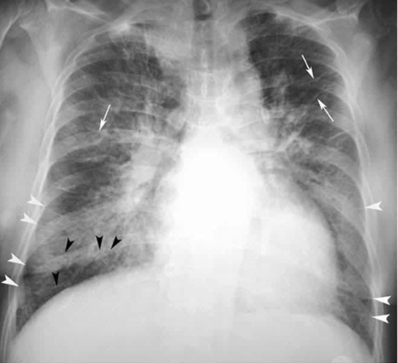 <p>Radiological findings - CHF mild vs moderate vs severe</p>