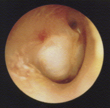 <p><u>disordered otoscopy: middle ear</u></p><p>cholesteatoma</p>