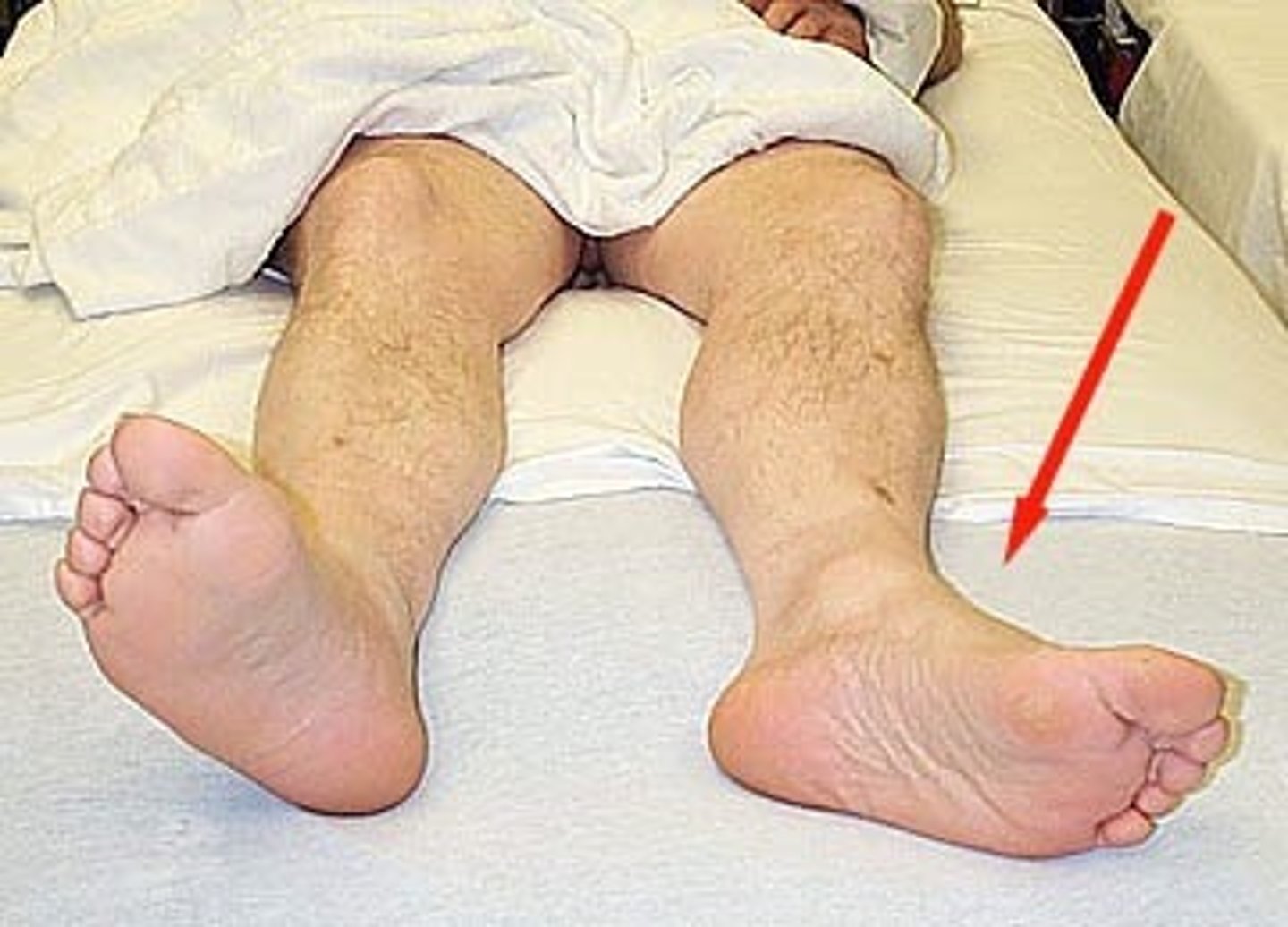 <p>Hip fracture</p>