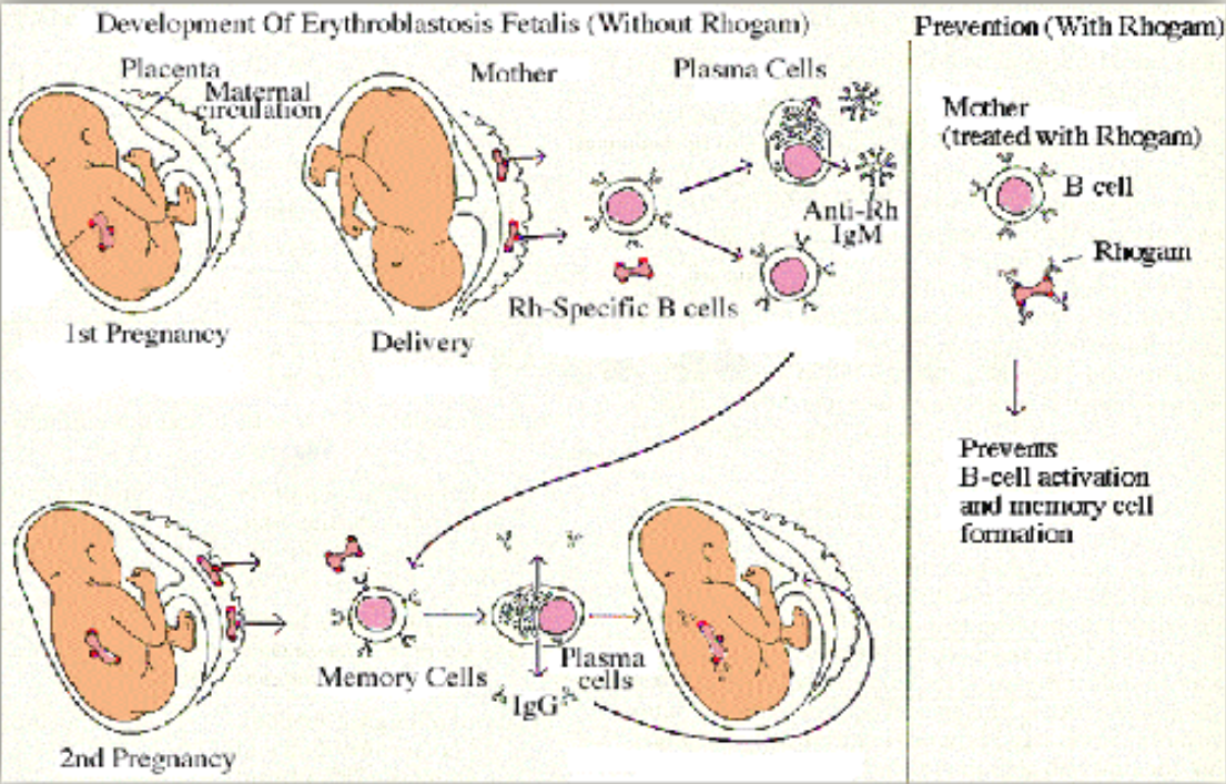 <ul><li><p>Rh HDFN is often severe</p></li><li><p>Rh antigens are well developed on fetal RBCs and Rh antibodies are transplacental IgG antibodies</p></li><li><p>Clinical intervention</p><ul><li><p>Rh-immune globulin (Rhogam) is a purified preparation of IgG anti-D</p></li><li><p>Administered to D-negative women during pregnancy and after delivery of a D-positive fetus</p></li><li><p>Rh-immune globulin is effective only in preventing RhD HDFN</p></li></ul></li></ul><p></p>