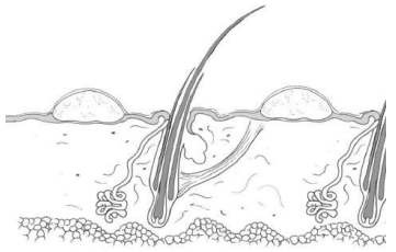 <p>Acúmulo de pus bien delimitado dentro de la epidermis</p><p>Dermatitis por bacterias y hongos, pénfigo foliáceo y enfermedad epidermal estéril</p>