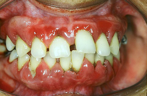 <p><span>A loss of stippling. This is initially caused by swelling or edema of the gingival tissues. In a diseased state, the gingiva may become red-whitish or have ulcerations or outgrowths of the mucosa.</span></p>