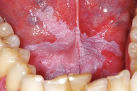 <p>type of leukoplakia that is uniformly white</p>