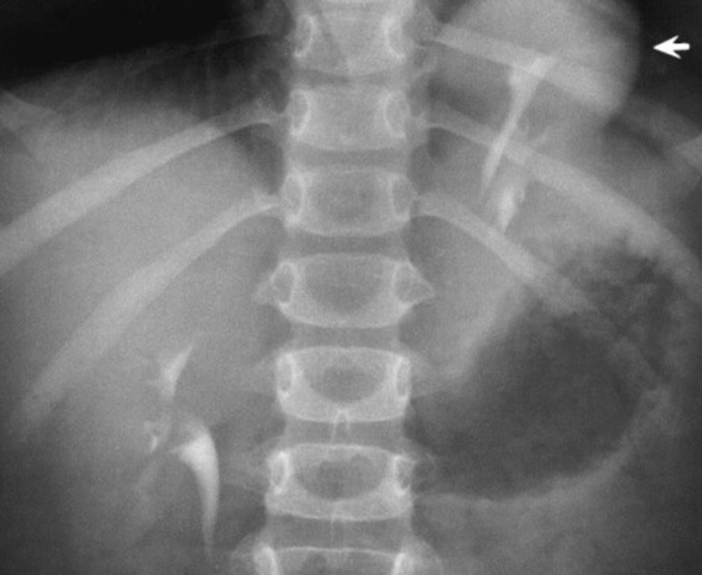 <p>What congenital anomaly refers to a type of ectopic kidney that is located above the diaphragm?</p>