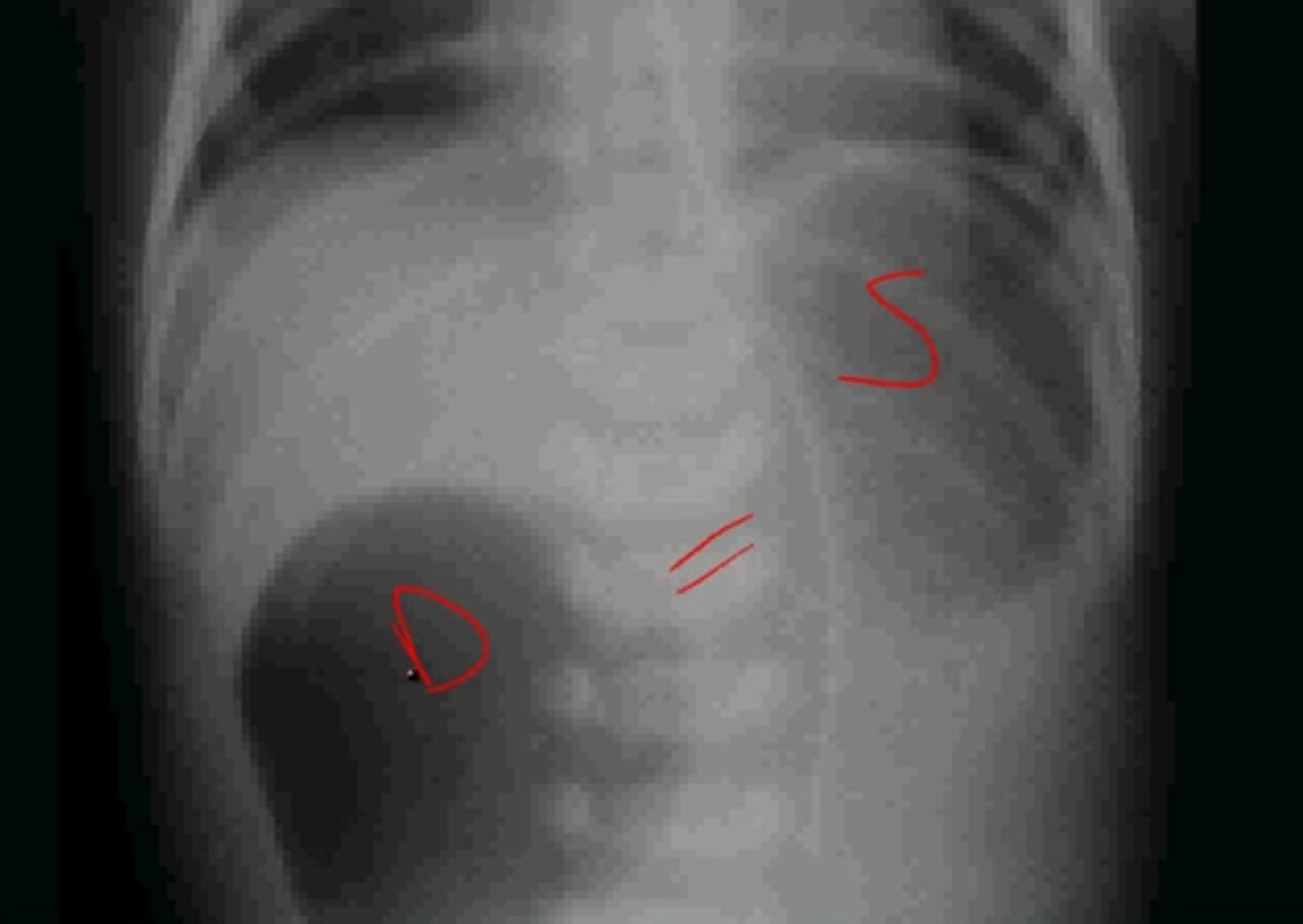 <p>Abdominal x-ray - shows "double bubble" sign; need to r/o volvulus (contrast enema can d/dx these)</p>