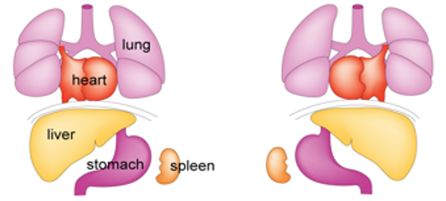 <p>Organs flip flopped</p>