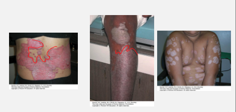 <ul><li><p><strong>Well-circumscribed, salmon-colored plaques</strong> with <strong>silvery scale.</strong></p></li><li><p>Common sites: <strong>elbows, knees, scalp, neck, gluteal cleft.</strong></p></li></ul><p></p>