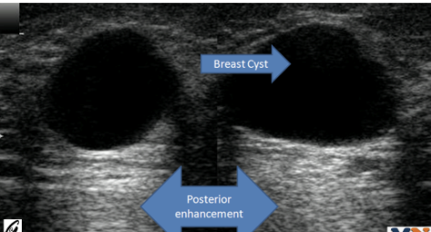 <p>What is posterior enhancement?</p>