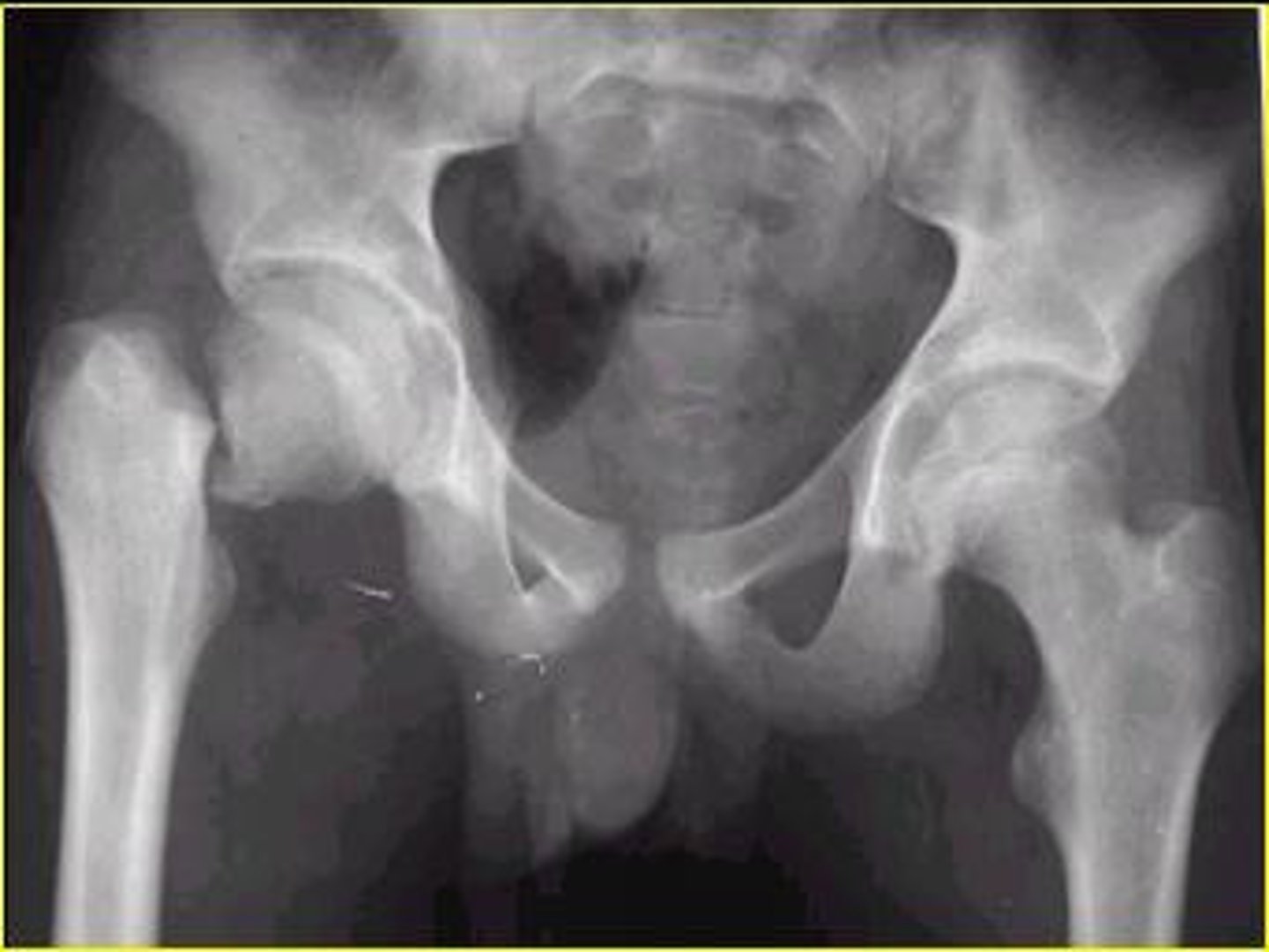 <p>Fracture of the neck of the femur</p>