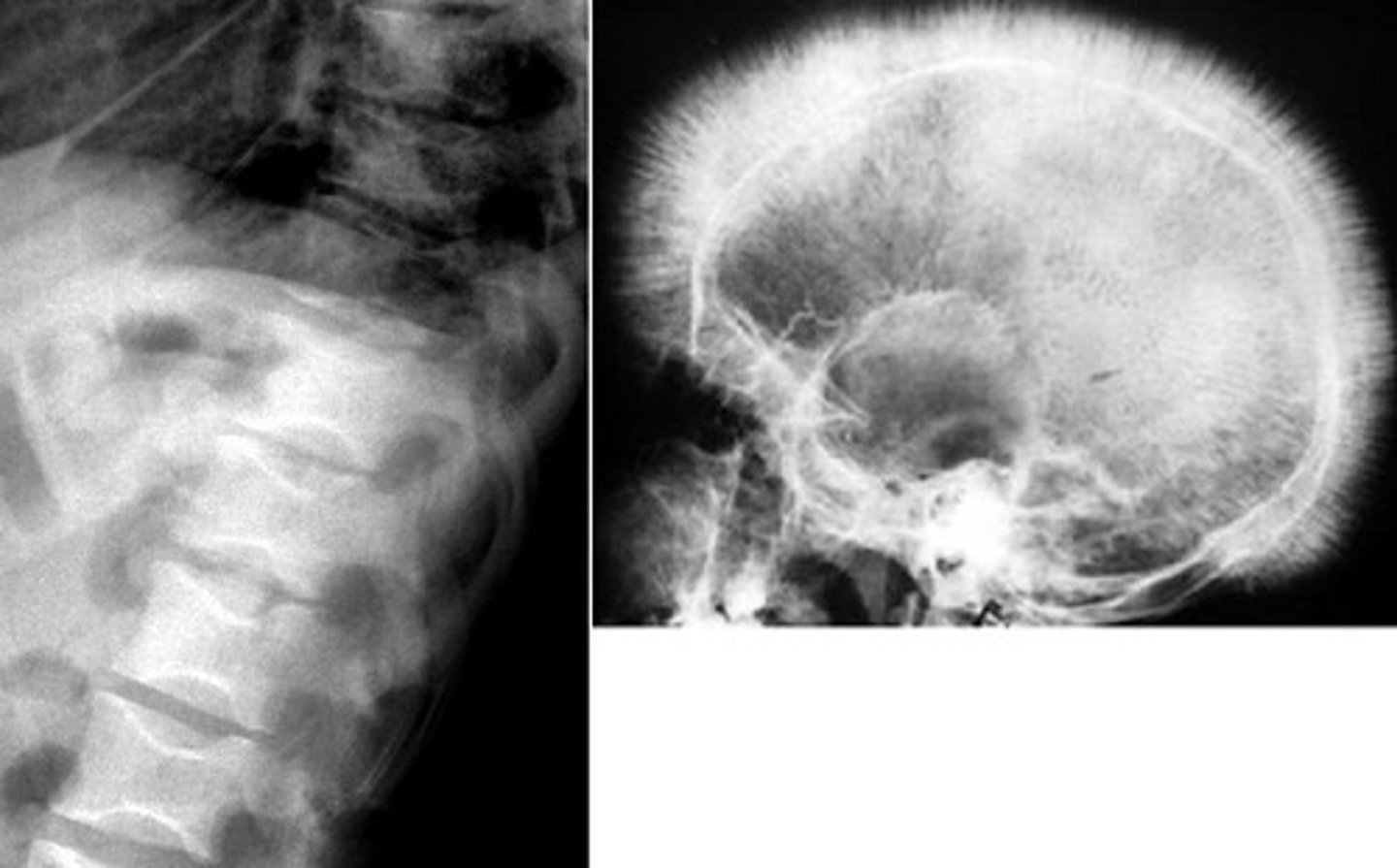<p>what are the radiologic findings associated with beta thalassemia major?</p>