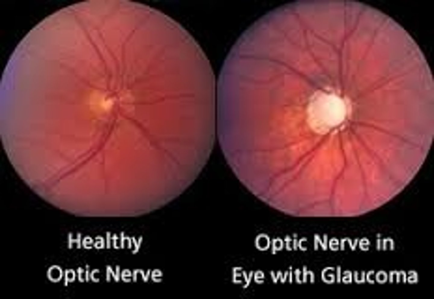 <p>Enlarged cup covers half the optic disc</p>