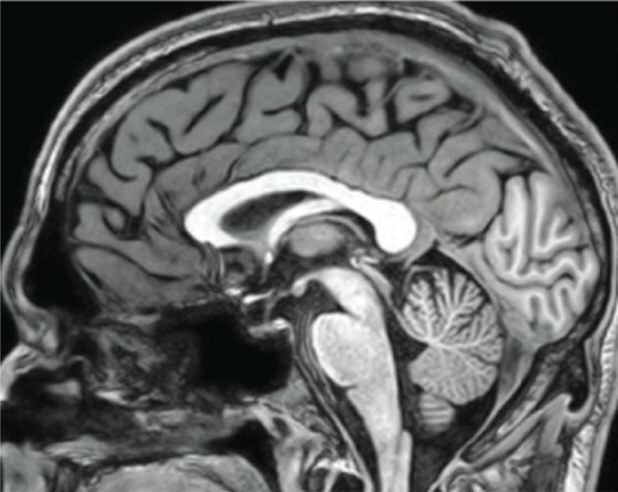 <p>Looking in the brain from the side:</p>
