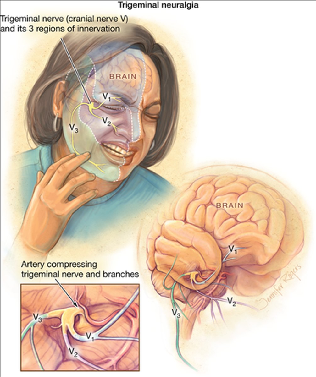 <p>intense pain on one side of face - forehead, cheek, nose, jaw - s/s frequent blinking, tearing of eye</p>