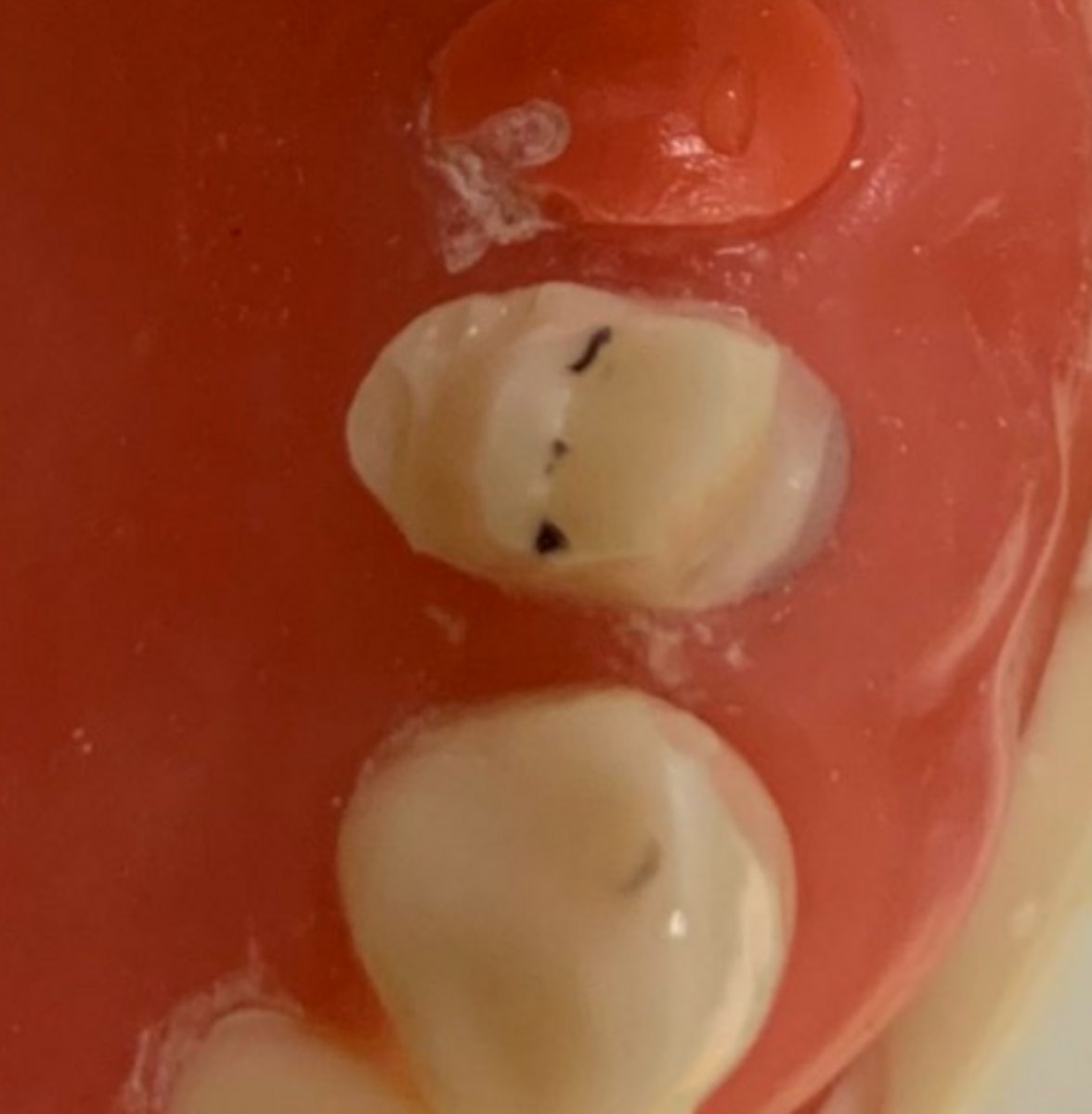 <p>What is wrong with the tooth prep on #5?</p>