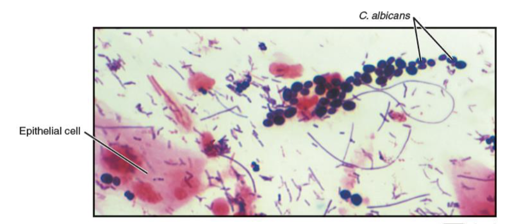 <ul><li><p>reproductive fungal disease</p></li><li><p>cause; <em>C. albicans</em></p><ul><li><p>virulence: opportunistic</p></li></ul></li><li><p>transmission: overgrowth of <em>C. albicans</em> in vagina and vulva</p></li><li><p>symptoms: disrupts vaginal microbiota or immunity (such as uncontrolled diabetes, altered vaginal pH, hormone changes, and prolonged antibiotic therapy)</p></li></ul><p></p>