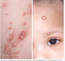 <p>Molluscum Contagiosum; </p><p><mark data-color="blue" style="background-color: blue; color: inherit;">viral skin infection that causes raised, pearly lesions. It is often benign and self-limited in healthy individuals. </mark></p>