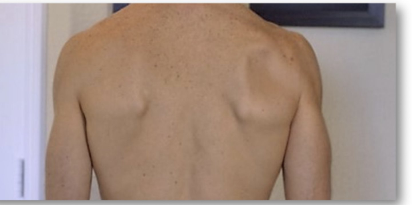 <p>weakness of the infraspinatus muscles</p>