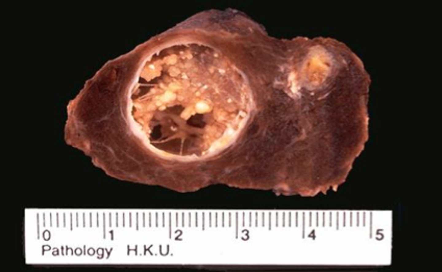 <p>tumor is pale white with cystic degeneration</p>