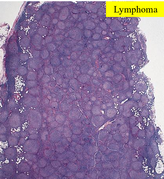 <p>Low grade B-cell NHL causing B-cell lymphocytes to be arranged in follicular pattern in LN’s. Commonly affects >50yrs</p><p><u>Pathogenesis</u>: translocation of BCL2 gene on chr 18 with IgH gene on ch 14, causing overexpression on BCL2 gene which inhibits apoptosis. This forms a clone of mature B cells which fail to die by apoptosis, resulting in geriatric overcrowding</p><p><u>Diagnosis:</u></p><ul><li><p>Signs non-contiguous lymphadenopathy, fever, night sweats, weight loss</p></li><li><p>CD19 &amp; CD20 positive immunohistochemistry</p></li></ul><p><u>Treatment</u>: Chemotherapy and/ or immunotherapy (e.g.rituximab)</p><p><u>Prognosis</u>: not curable, survival 7-9 years</p><p></p>