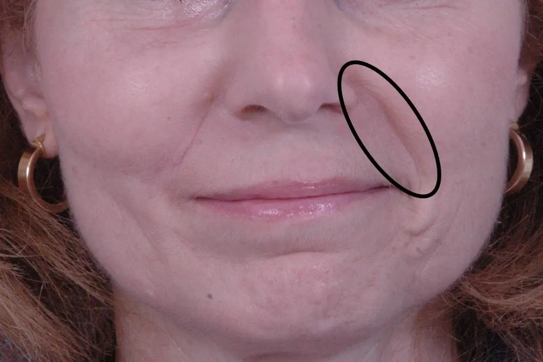 <p>Nasal sulcus</p><p>(See the words nose and nasolabial, we are dealing with the nose area) </p>