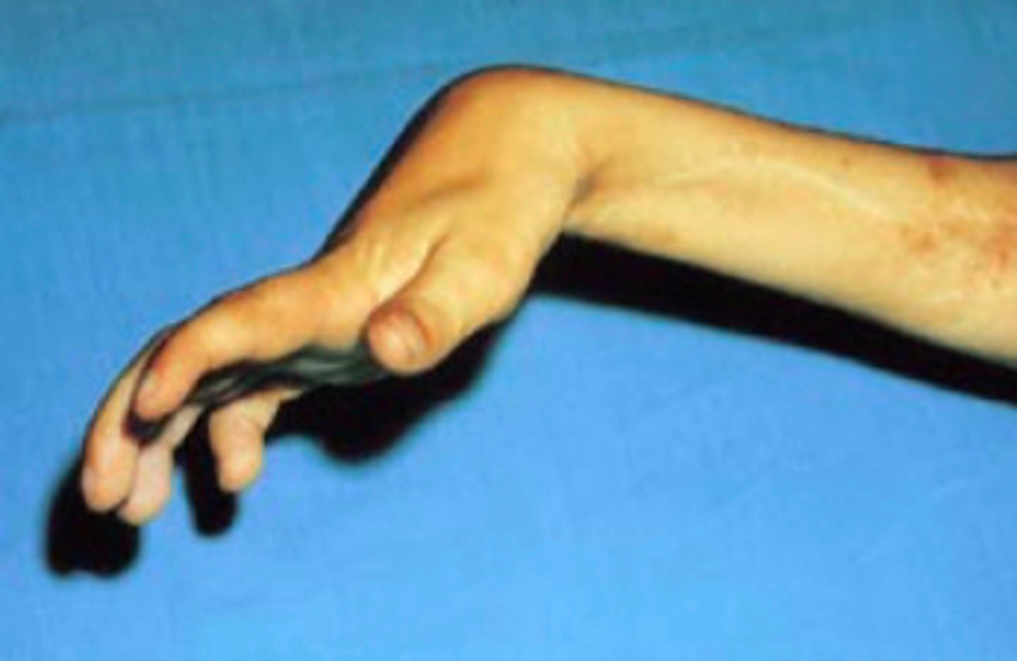 <p>flexion contraction of the wrist and fingers resulting in limited extension at these joints. A decrease in blood supply to then forearm muscles</p>