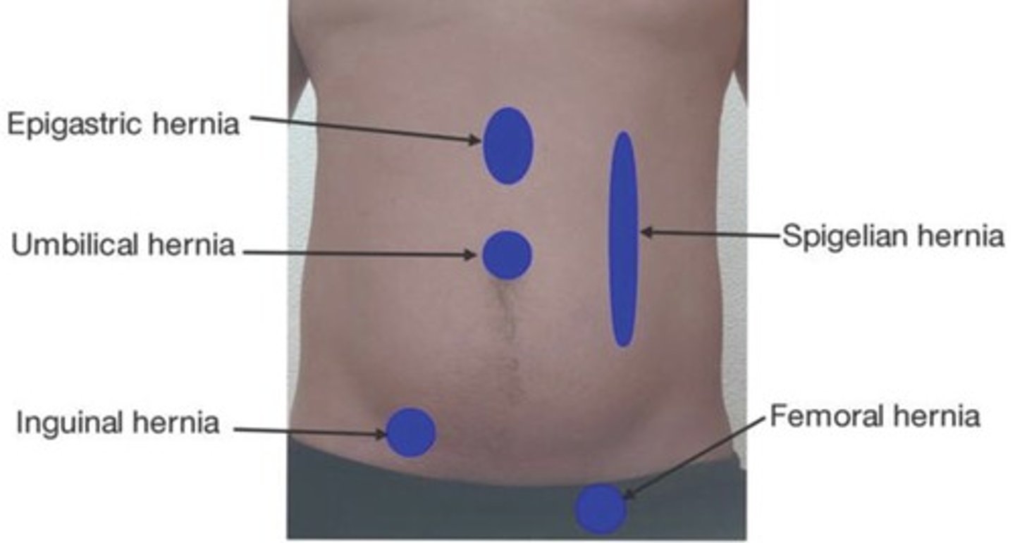 <p>Opening in abdominal wall with contents protruding through</p>