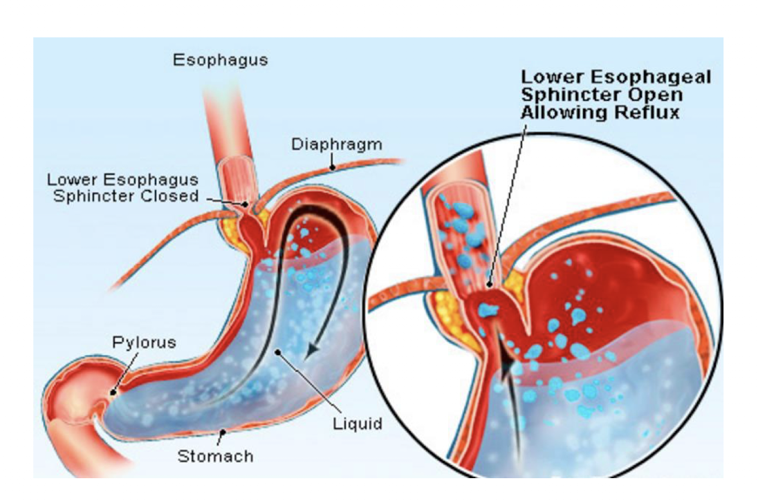 <p>Esophageal Pain: Gastroesophageal Reflux Disease (GERD)</p><ul><li><p>GERD is a consequence of what?</p></li></ul><p></p><p></p>