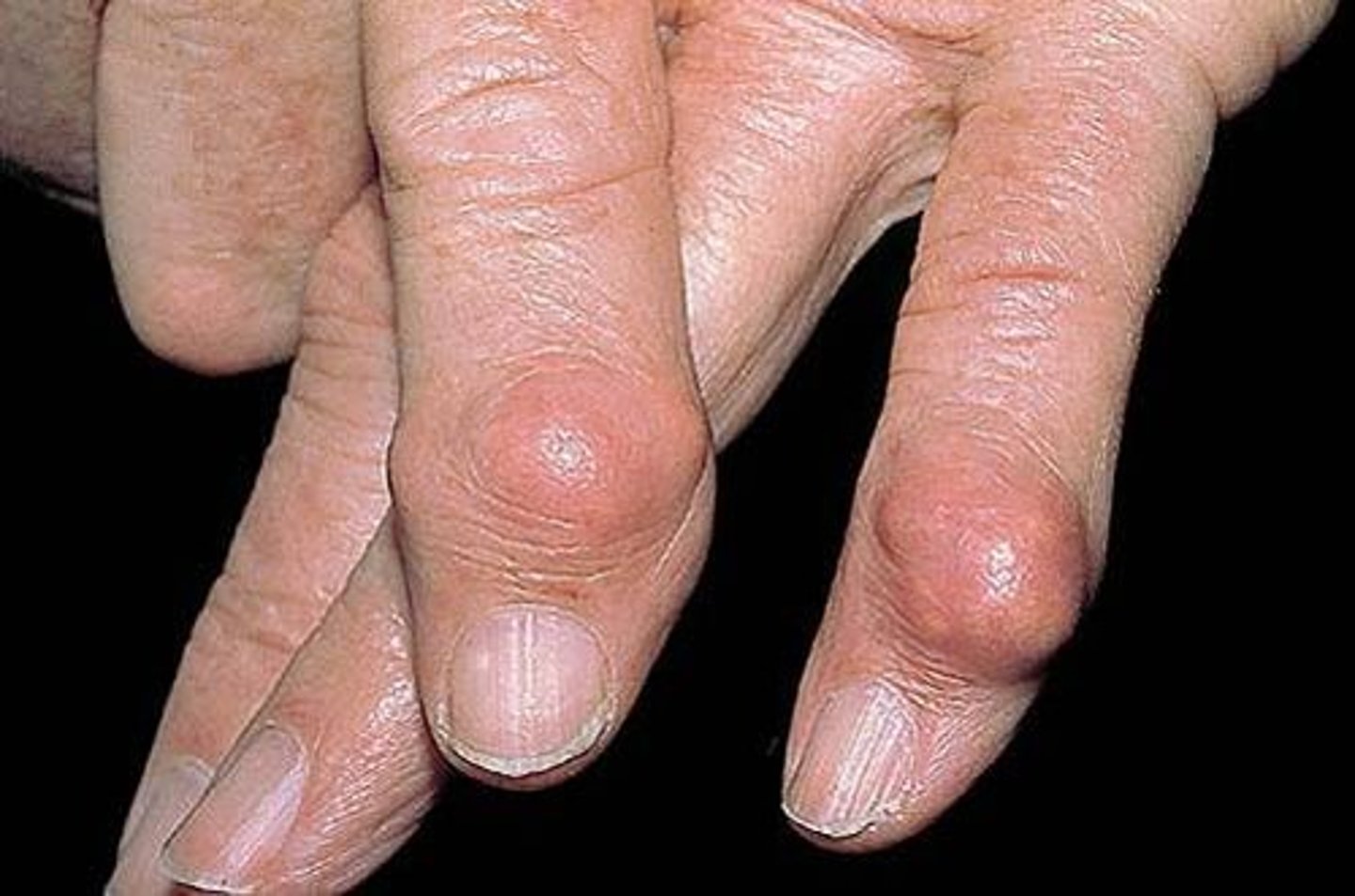 <p>large, solid bump</p><p>>0.5 cm</p>
