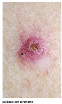 <p>Basal cell carcinoma</p>