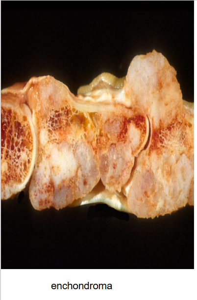 <ul><li><p>goedaardige tumor</p></li></ul><p></p>