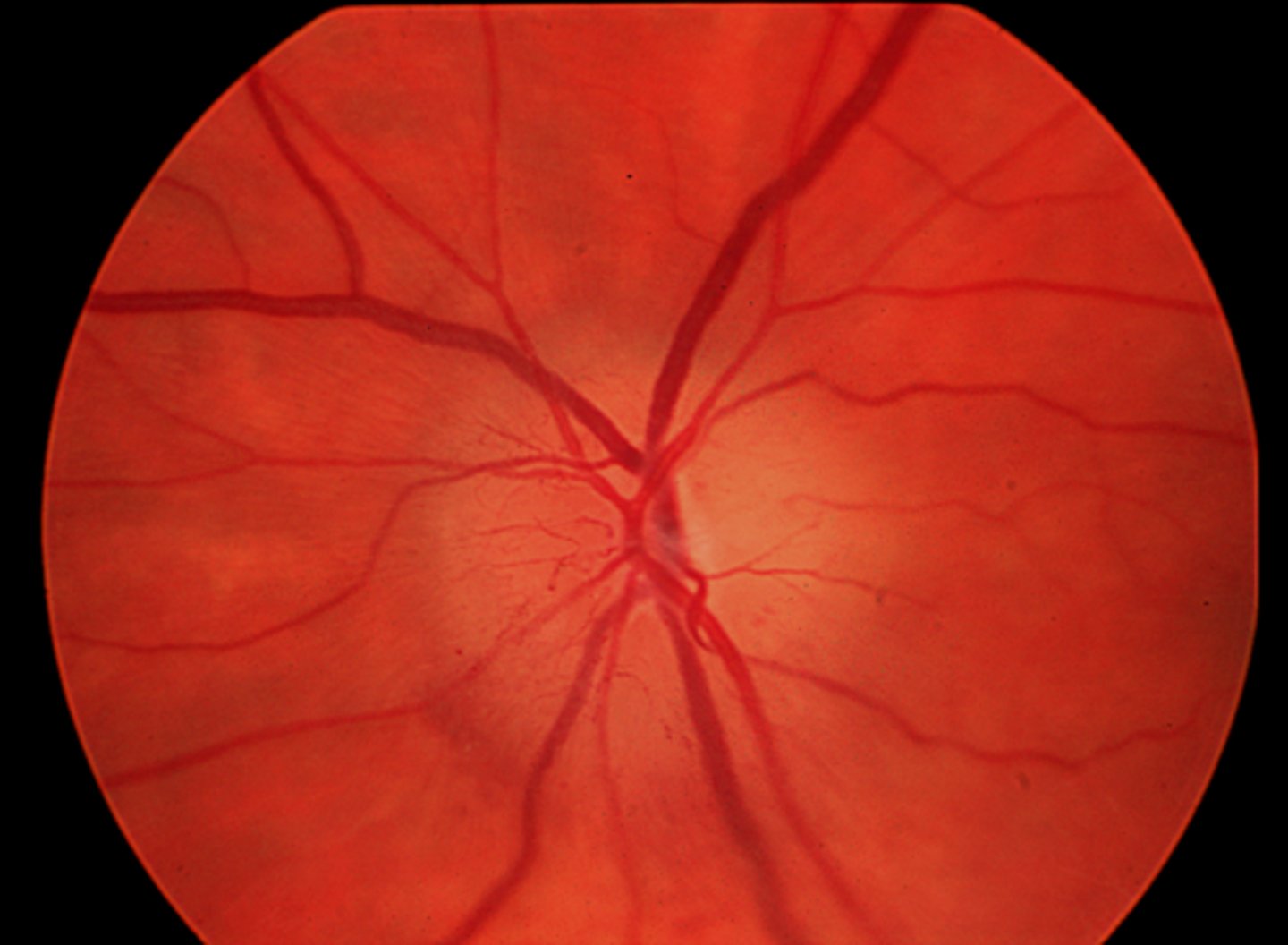 <p>papillitis with disc edema and good vision</p>