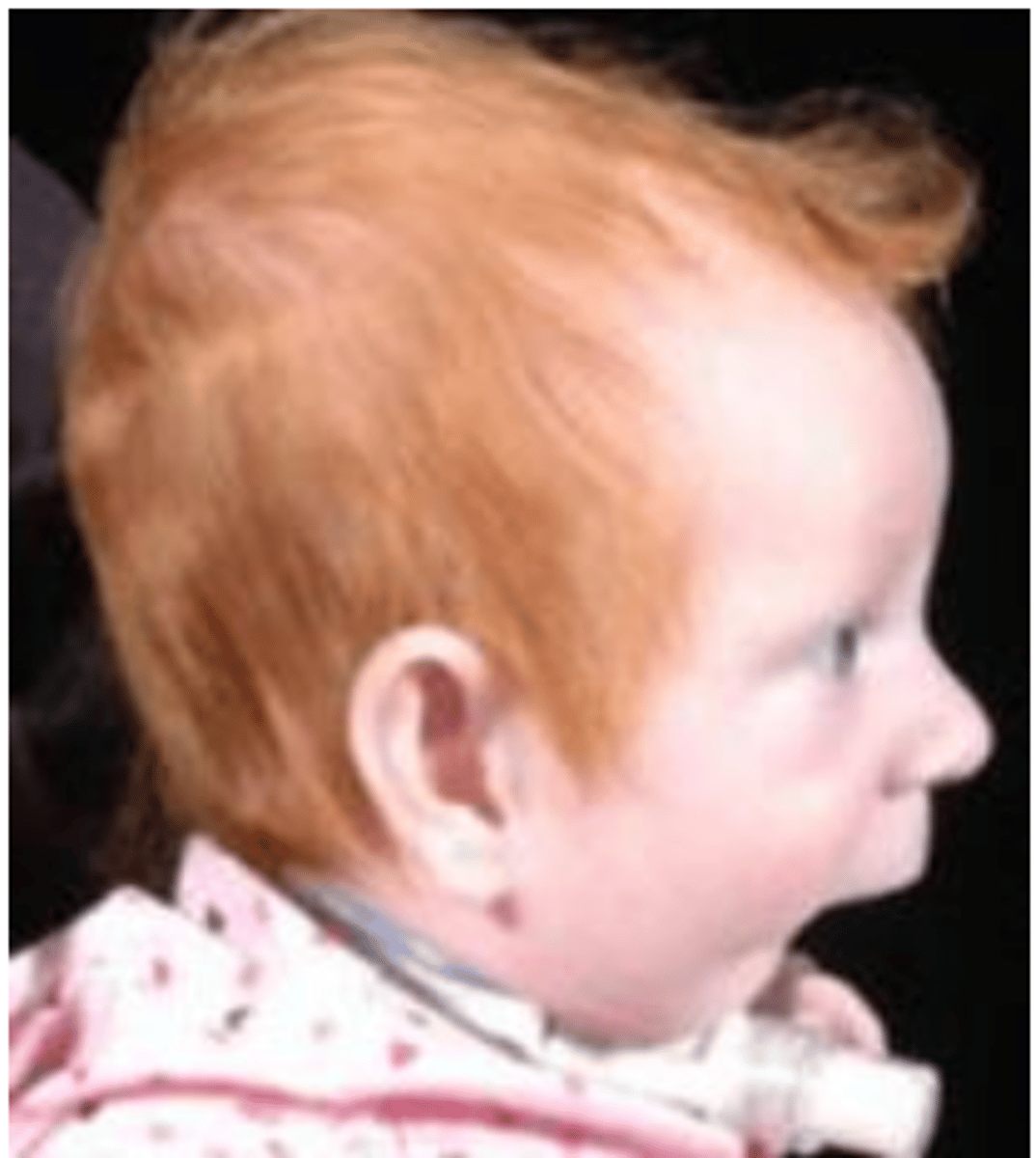 <p>• CP</p><p>• Mandibular micrognathia (small mandible) </p><p>• Glossoptosis (airway obstruction from posterior/lower displacement of tongue)</p><p></p><p>Probably from constraints in utero</p>